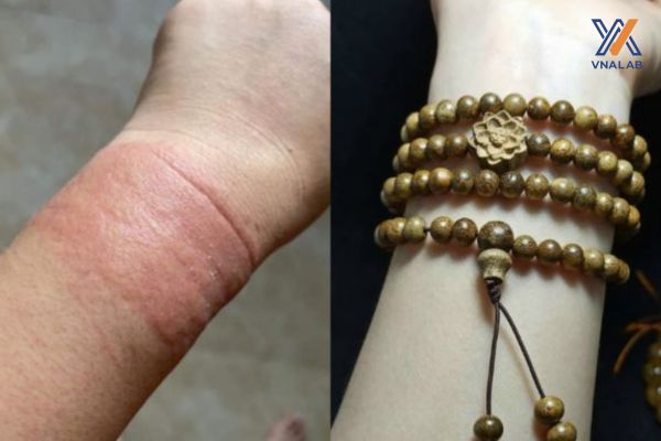 Đeo trầm hương bị dị ứng: Nguyên nhân và cách khắc phục