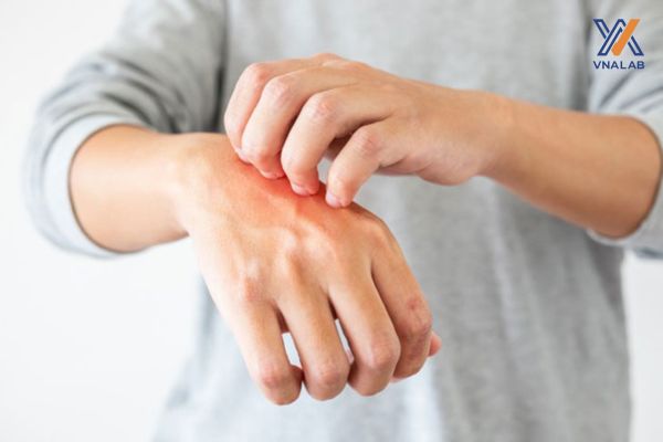 Cách khắc phục khi đeo trầm hương bị dị ứng